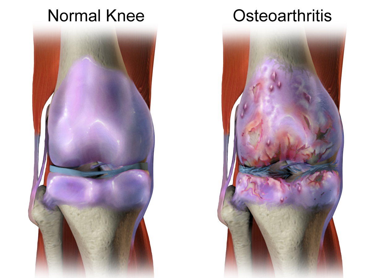 Arthritis, what is it?