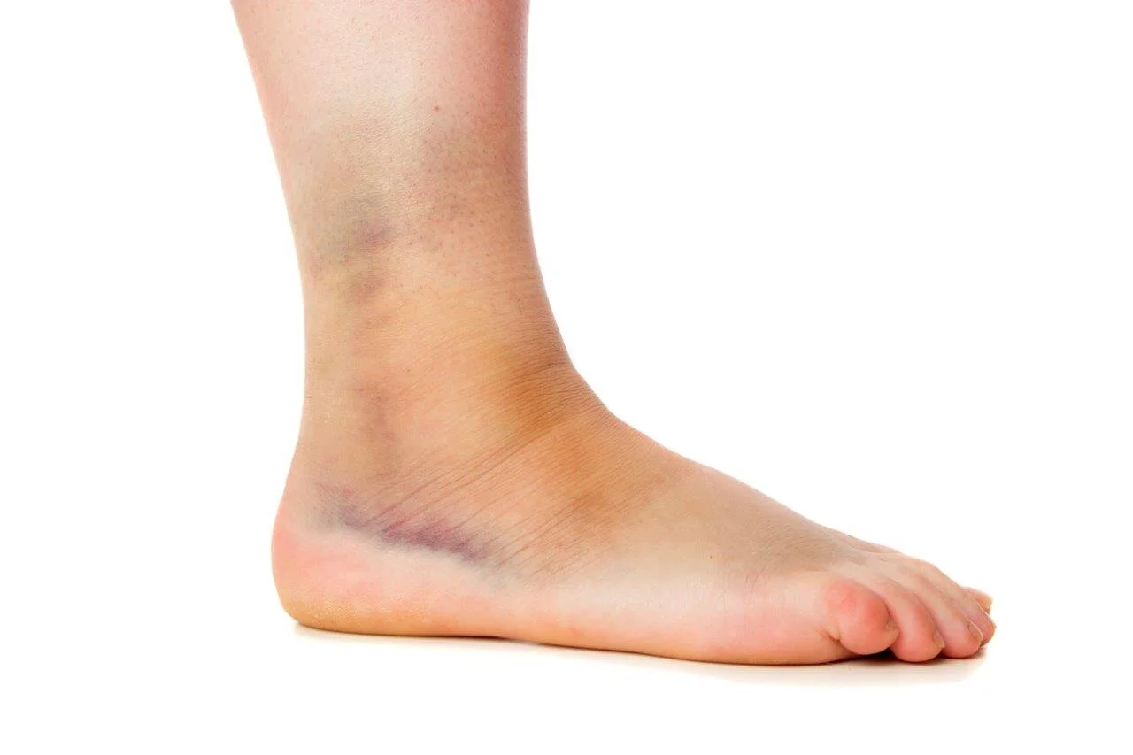 Ankle sprains and how to treat them