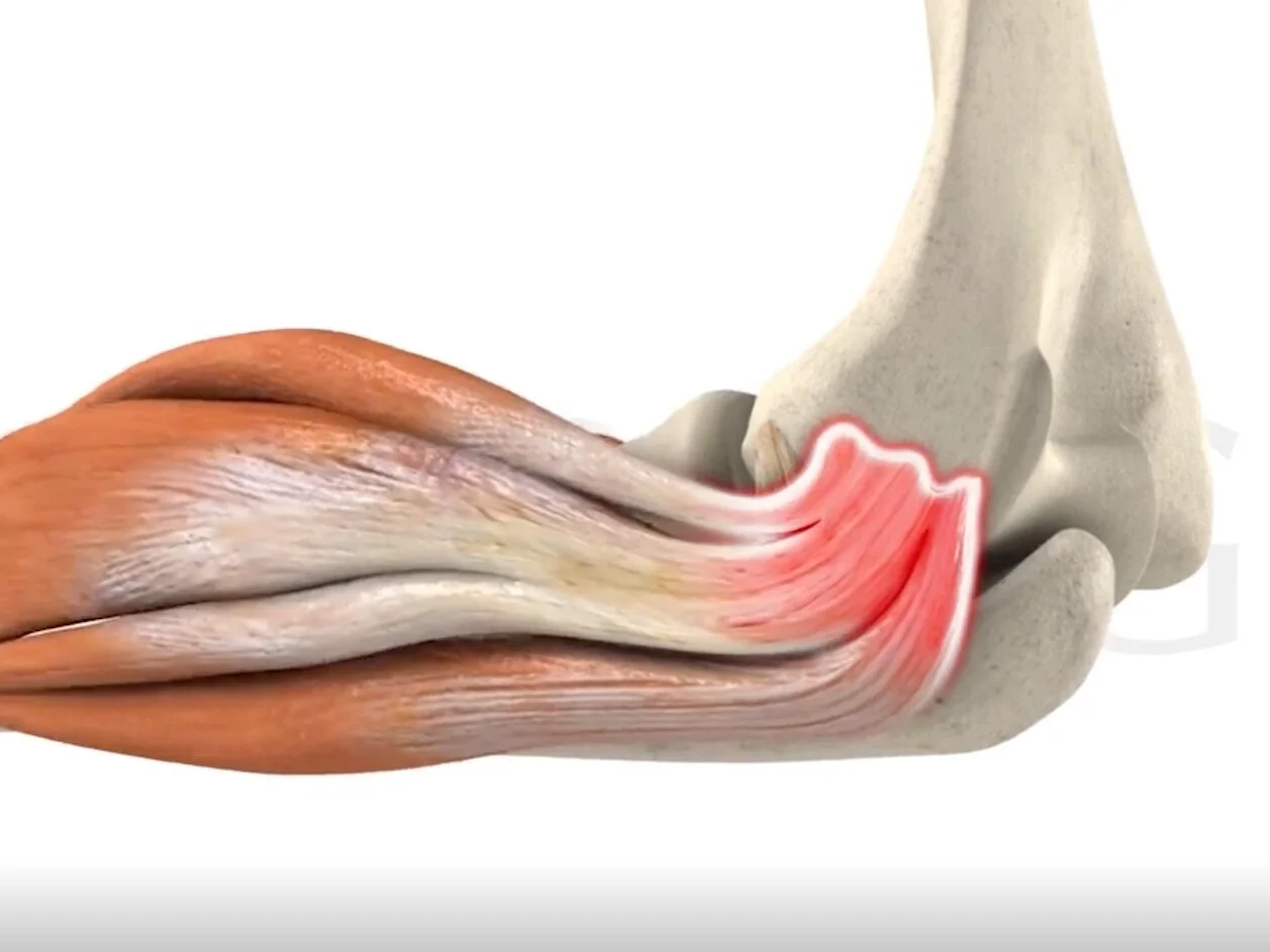 "The Big 5" Tendonitis, tendinosis, tendinopathy