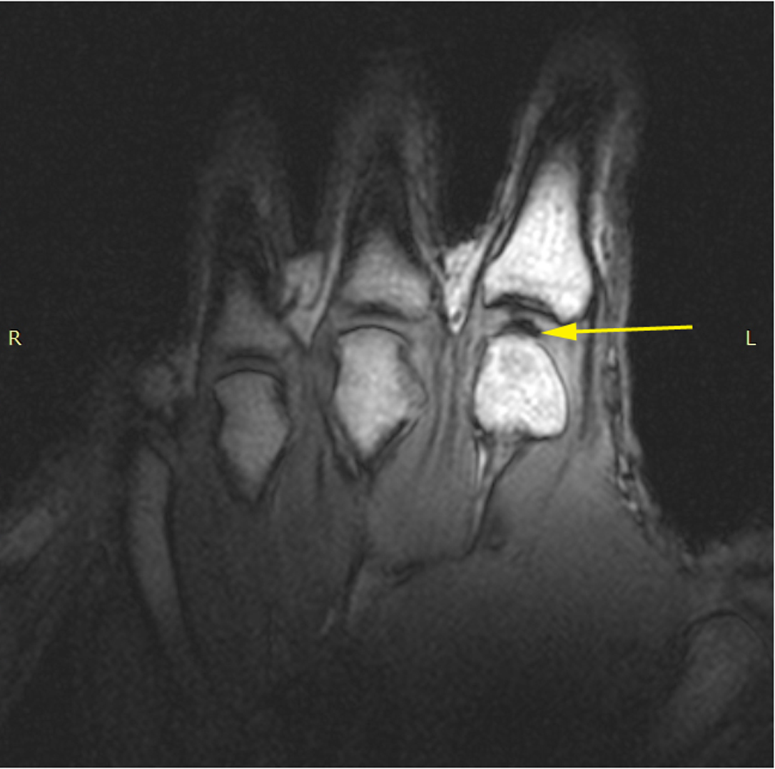 What happens when a joint "Cracks" or "Pops"?