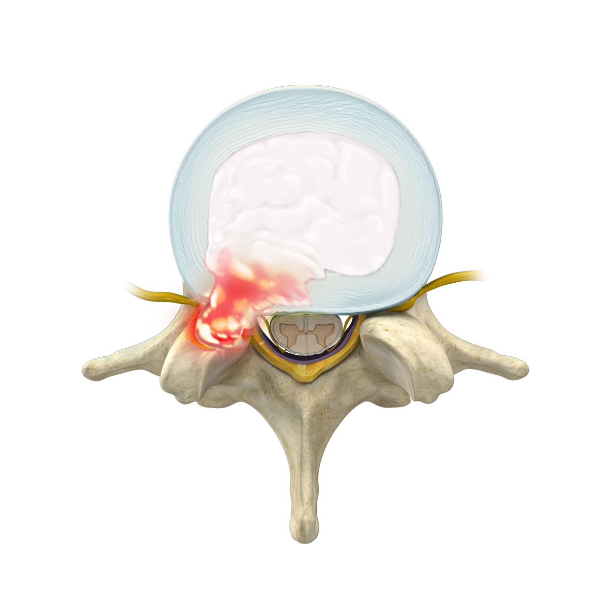 What is a disc herniation and can it heal?