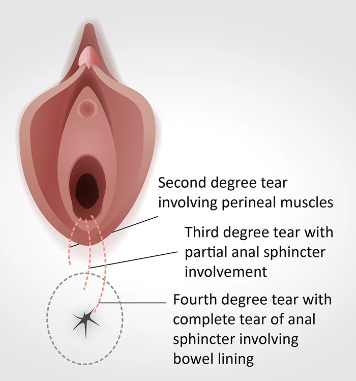 These degrees of tears happen during childbirth; first degree is most common from sexual intercourse. Photo courtesy of Royal College of Obstetricians and Gynaecologists