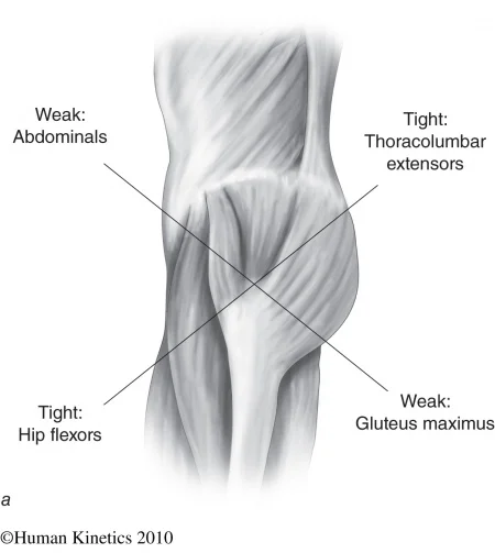 Lower Crossed syndrome
