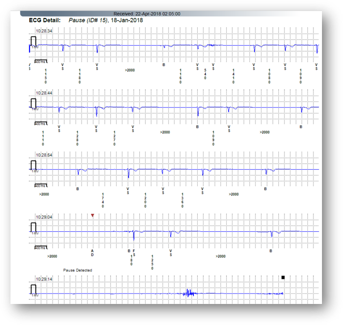 E2 - recurrent syncope taking a break.png