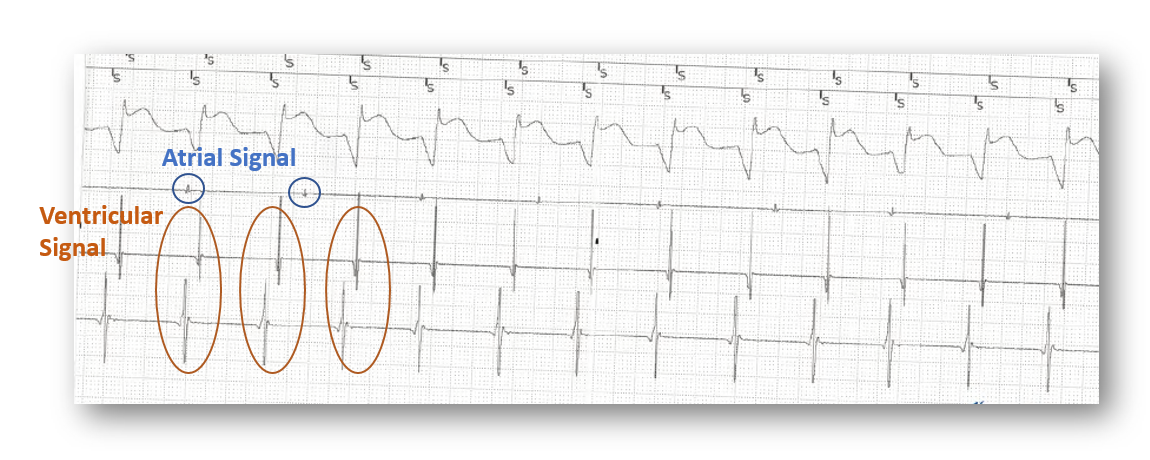 before treatment VT egm.png