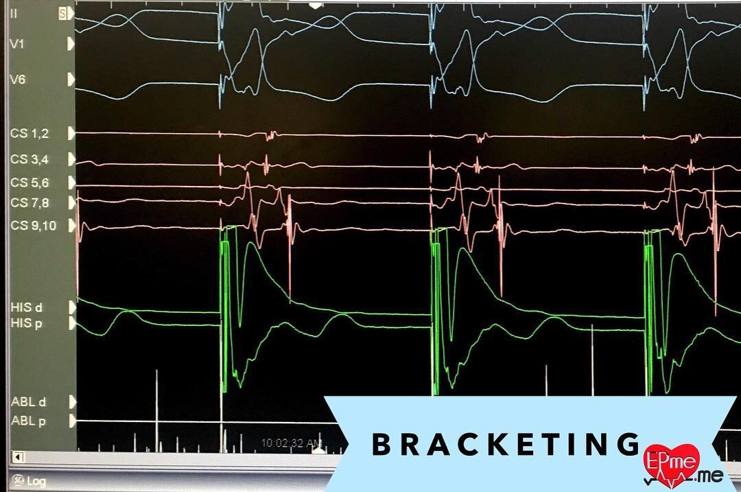 Bracketing baby!!!! #pacing #cardiology #cardiologynurse
#electrophysiology #ekg #ecg #heart
#heartrhythm #eps #ep #health
#medstudent #med #medic #medicine
#medical #catheterization #ablation
#cardiacablation #icd #defibrillator
#arrhythmia #pacemak