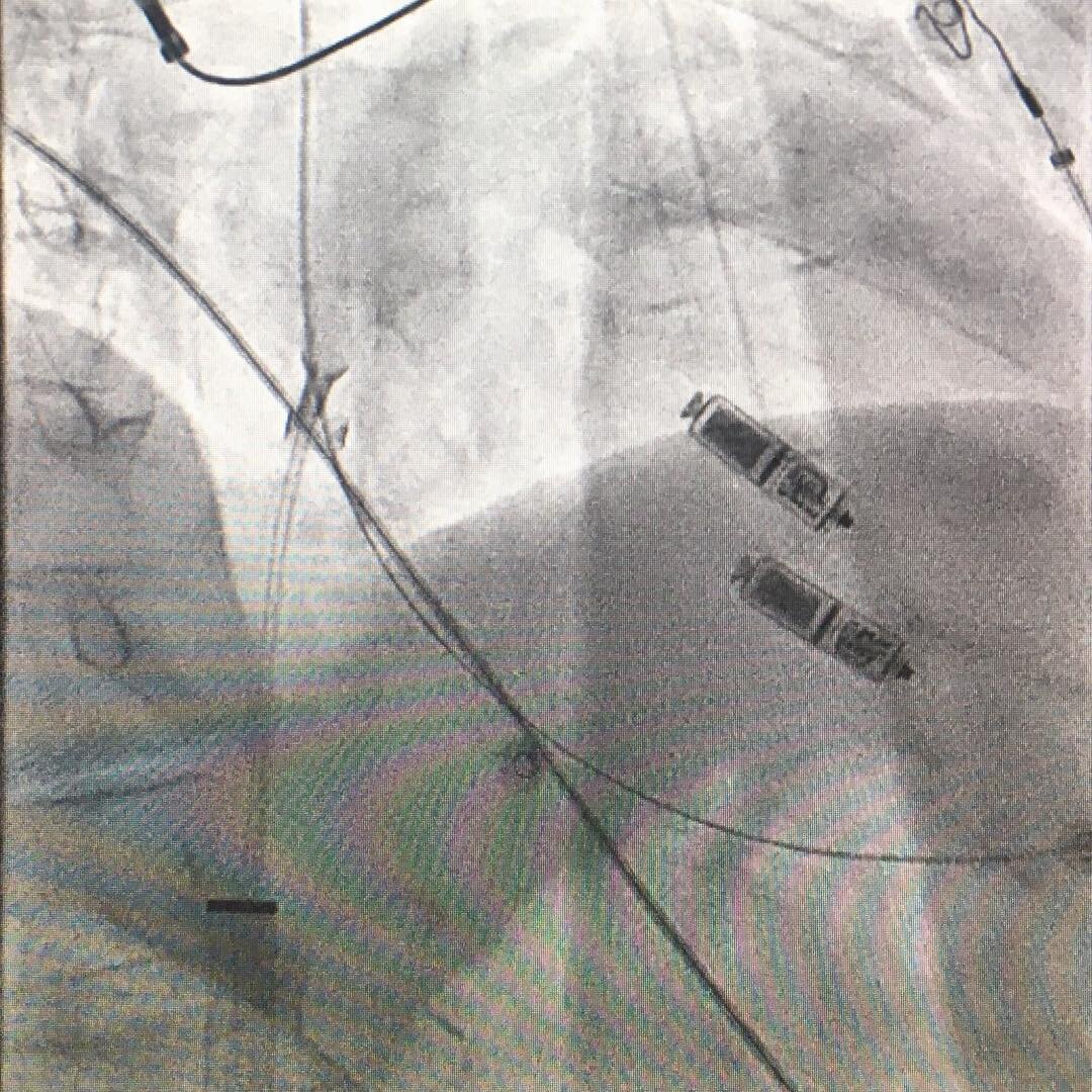 Seriously not that easy to extract a Micra!!!! #pacing #cardiology #cardiologynurse
#electrophysiology #ekg #ecg #heart
#heartrhythm #eps #ep #health
#medstudent #med #medic #medicine
#medical #catheterization
#arrhythmia #pacemaker #nursing
#nurse #