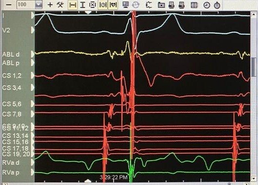 Great to ablate a slanted AP on the potential!!
#electrophysiology #ep #cardiacablation