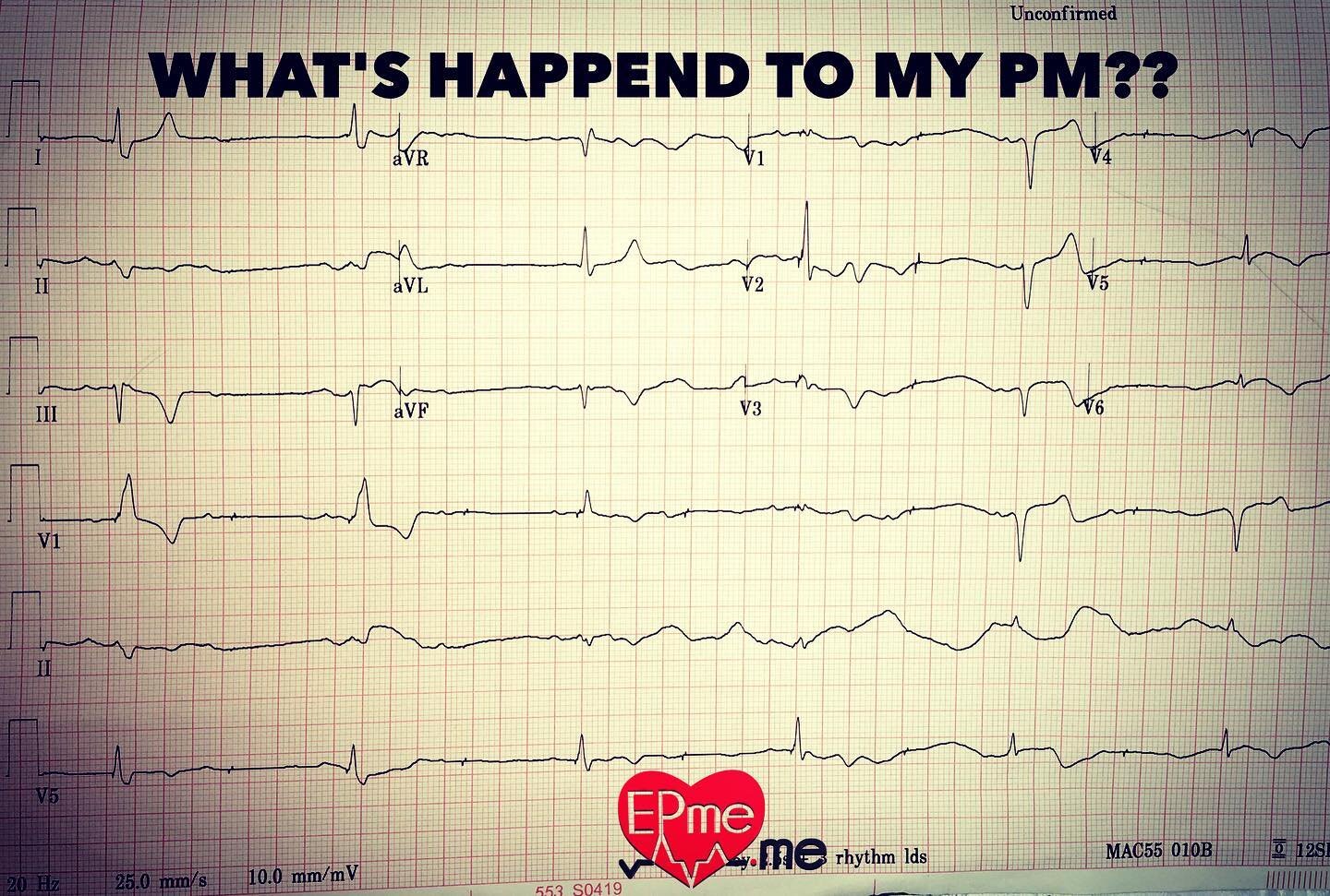 Patient 2 weeks post implantation from a small center opened to found electrodes not fixed.
 #pacing #cardiology #cardiologynurse
#electrophysiology #ekg #ecg #heart
#heartrhythm #eps #ep #health
#medstudent #med #medic #medicine
#medical #catheteriz