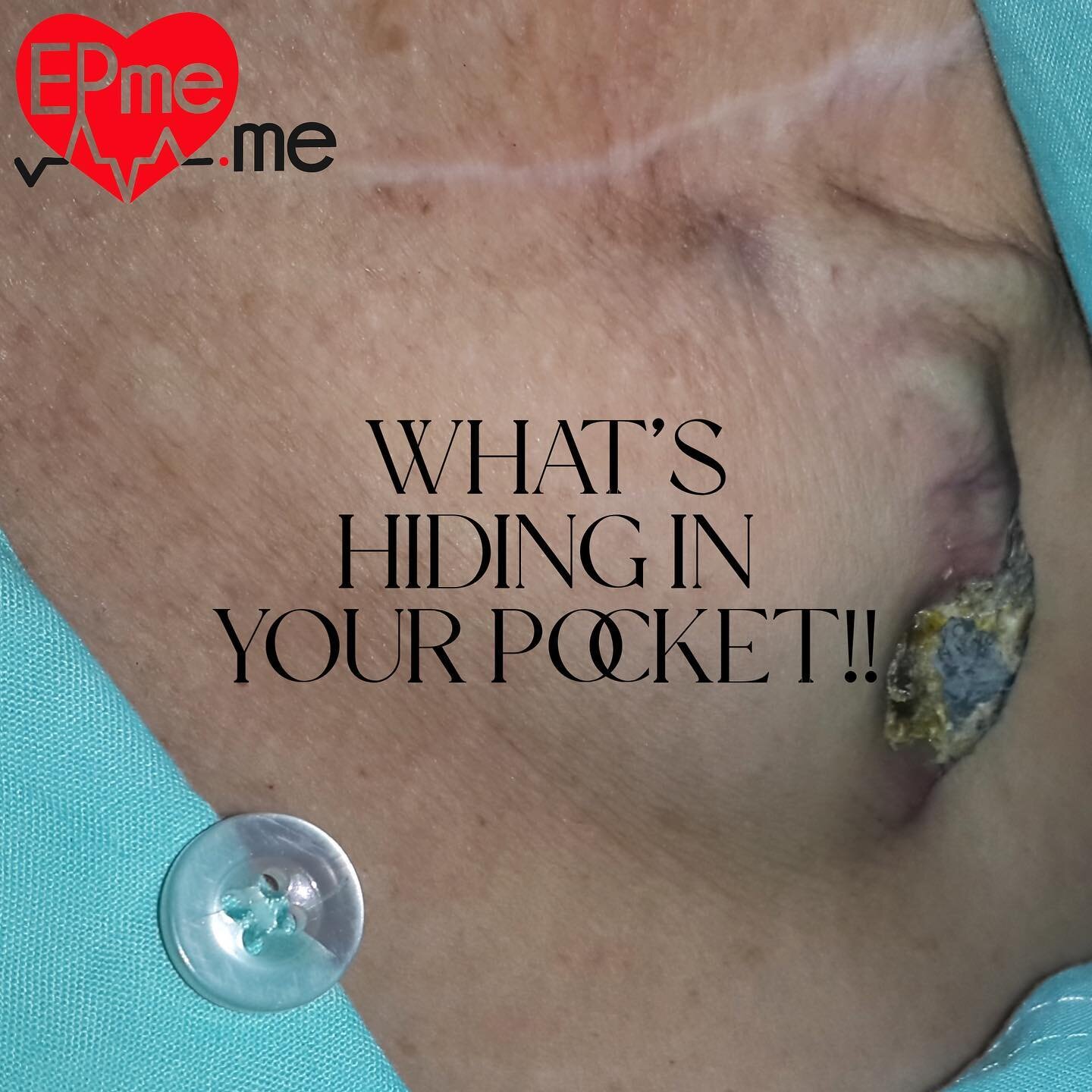 What&rsquo;s hiding in your pocket? #pacemaker #infection #electrophysiology #cardiology
