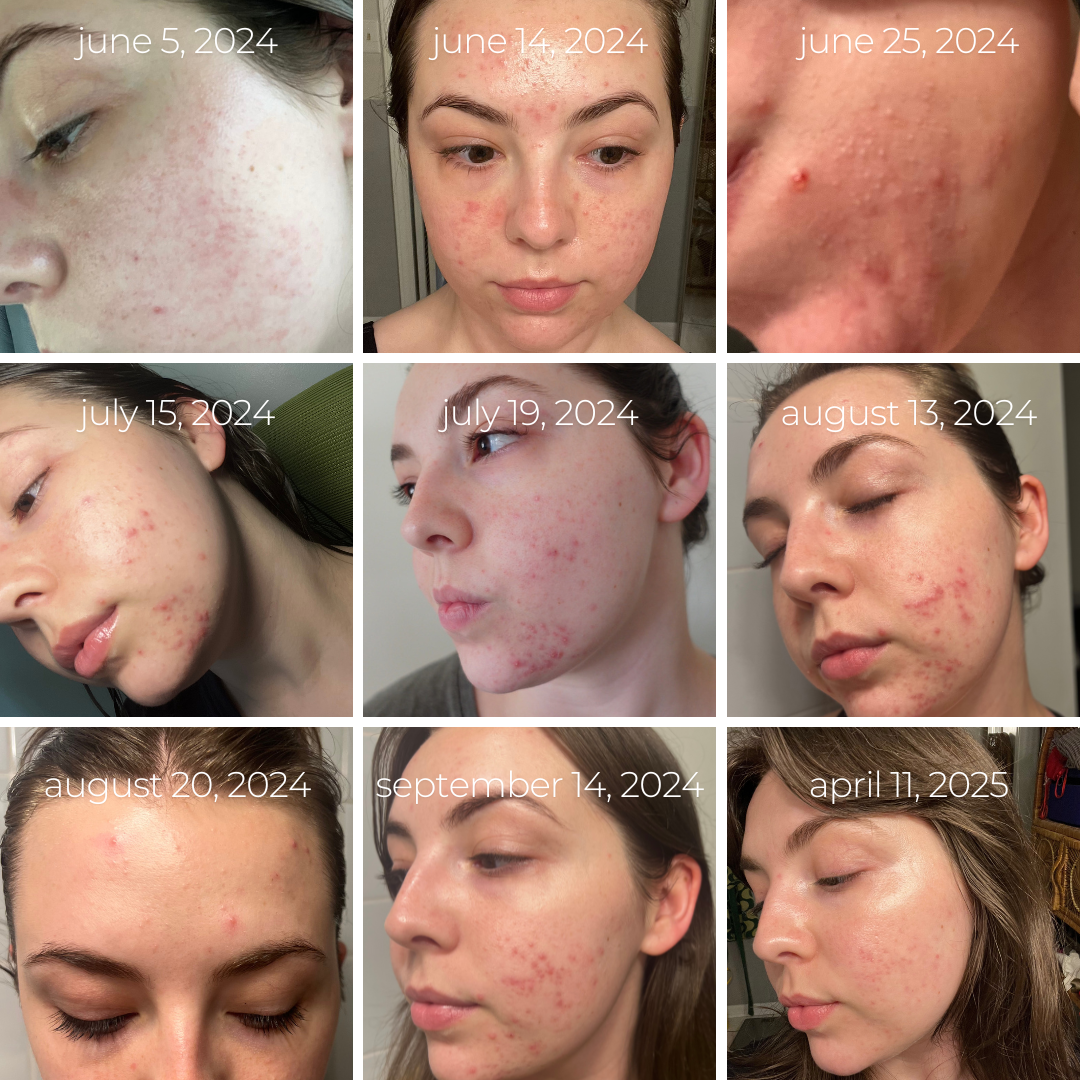A 9-month photo timeline showing acne healing progress from June 2024 to April 2025. The series features close-up images of a woman's face with visible acne and post-inflammatory erythema gradually clearing over time.