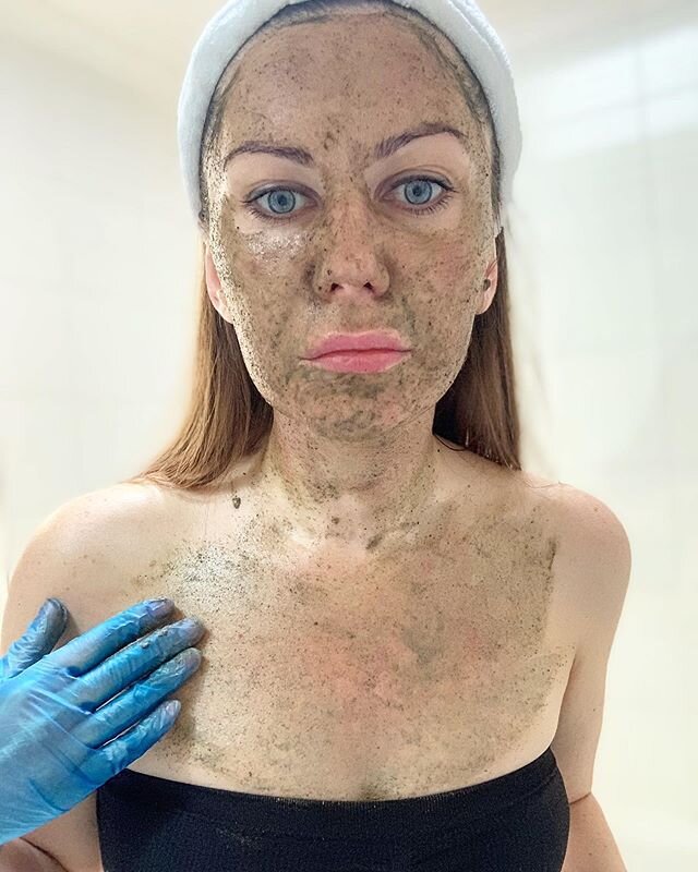 Here me having Deep Sea Peel and picture of my skin directly after the treatment - it looks like sunburn ☺️ -

When it begins to dry out around day three, the forehead, jawline and the cheeks, to some degree, will experience some shedding -

By day s