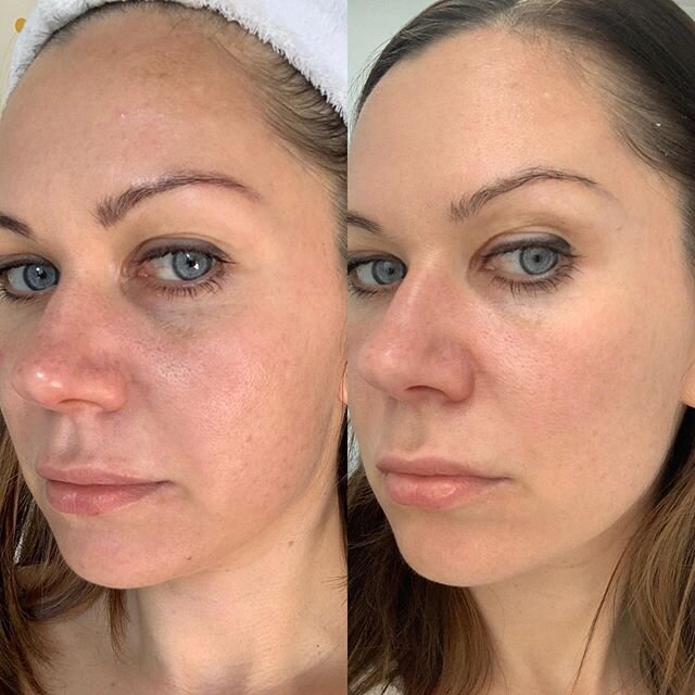 Not the most flattering pictures of myself 🤪 but want to share results after just one #cosmedix #deepseapeel -

My skin is prone to pigmentation and as much as I love the sun my skin doesn&rsquo;t 😏 I will always end up patchy, uneven and summer ti