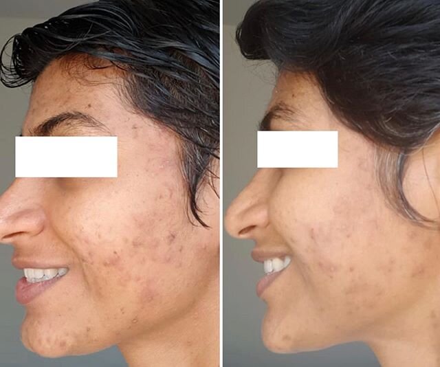 Thank you to my beautiful client for letting me share this with you. That&rsquo;s my client&rsquo;s skin journey since the lockdown. We we were unable to continue with professional treatments so we introduced some home treatments along with home care