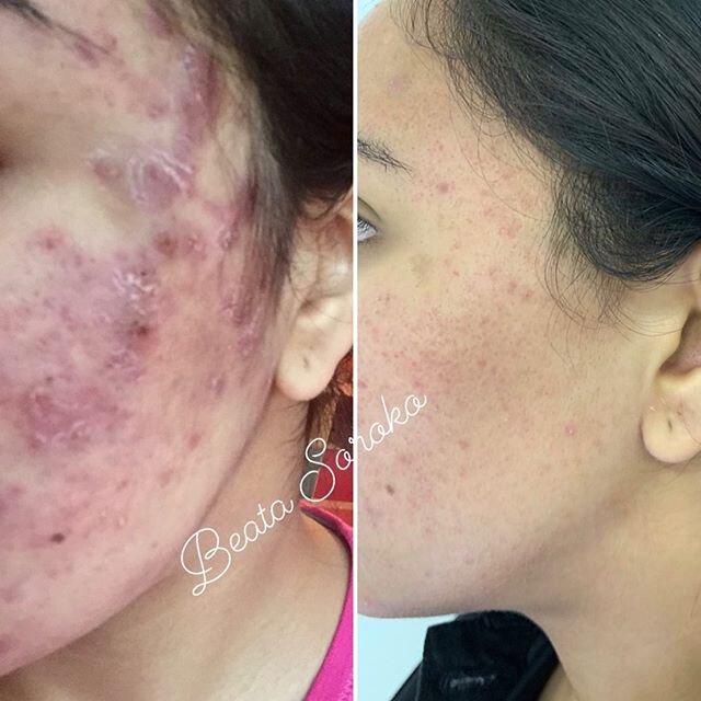 Skin transformation due to combination of skin peels, facials and microneedling treatments 👐🏻