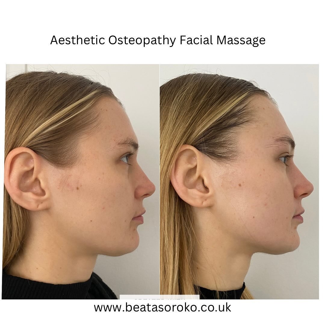 Aesthetic osteopathy facial massage  1 session on this beautiful client 🌺

What&rsquo;s Aesthetic Osteopathy Facial Massage? 

It is is a specialized technique that combines principles of osteopathy, a form of alternative medicine focused on the man