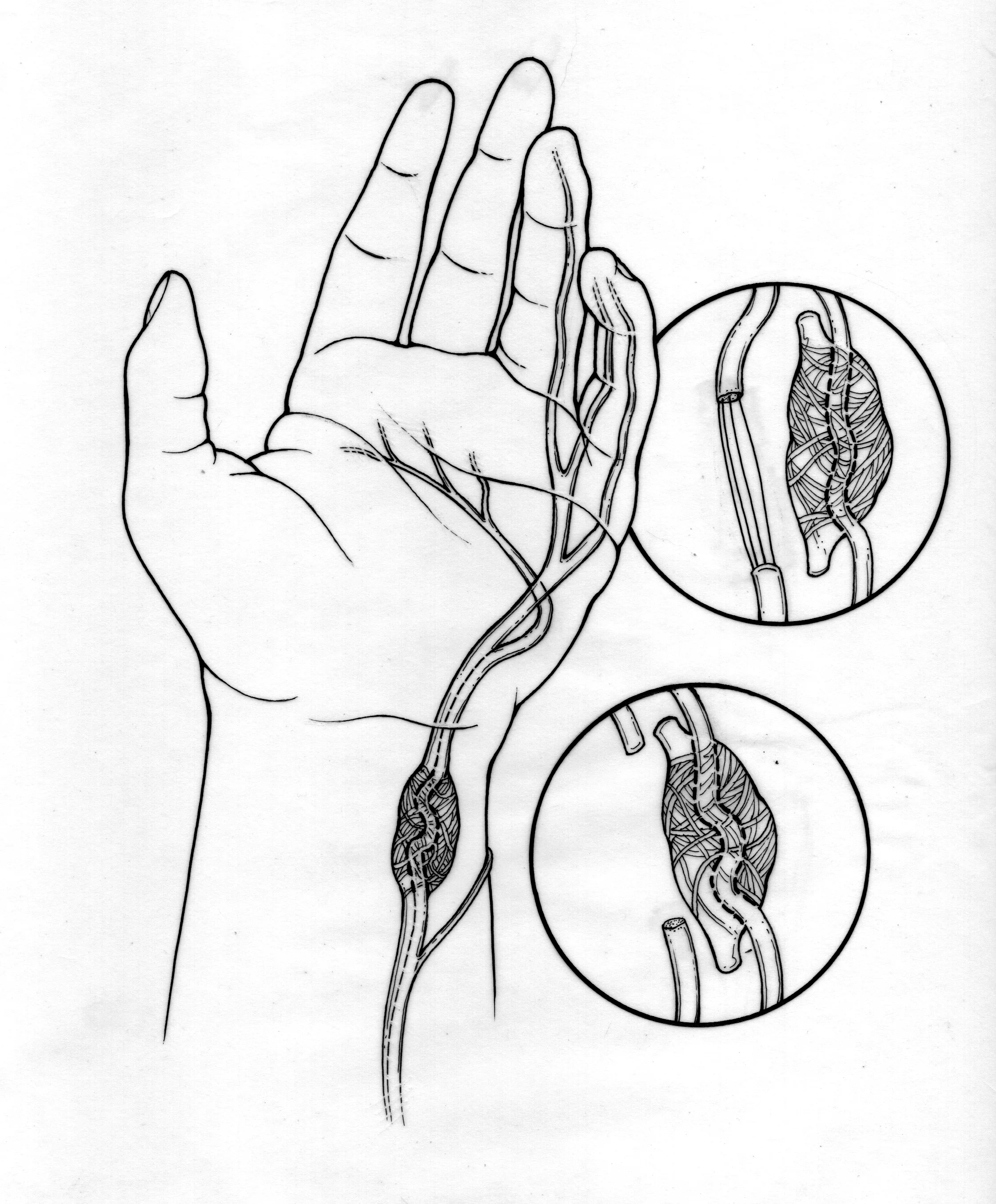 Ganglion Repair