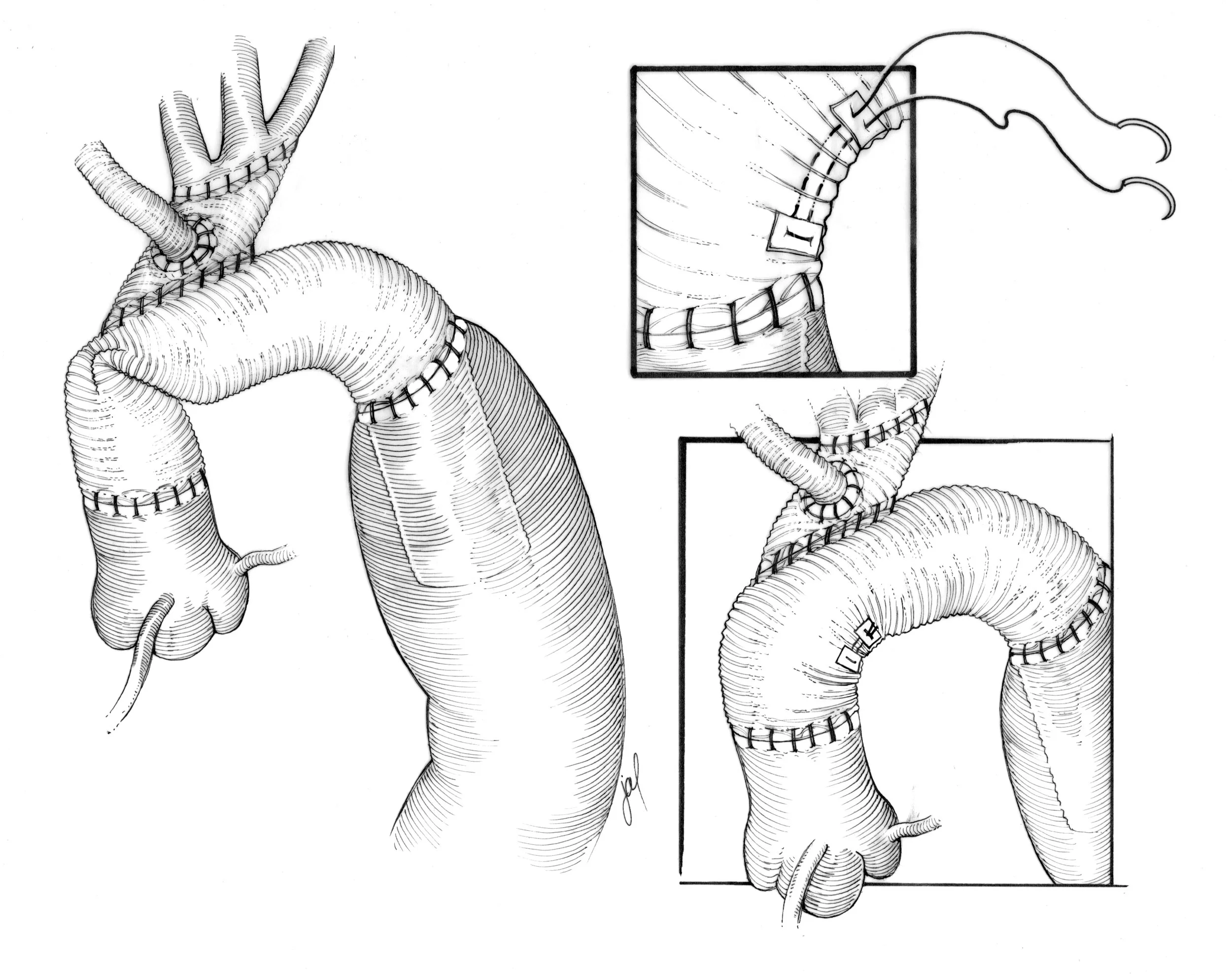 Aortic Graft Failure