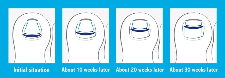 Can I fix my ingrown toenail non surgically?