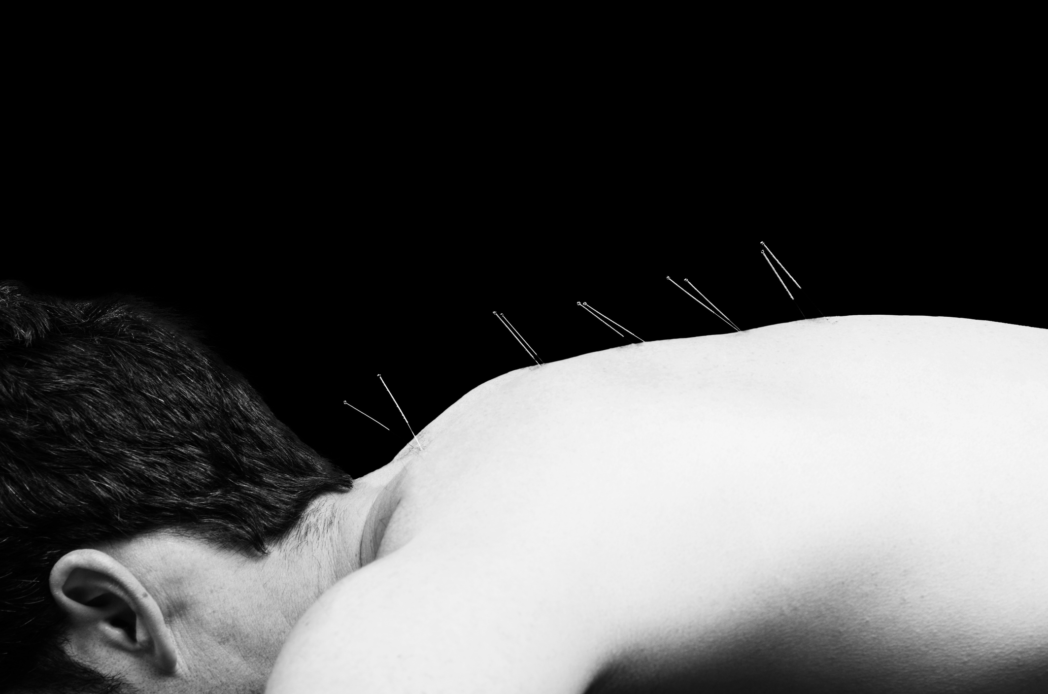Acupuncture
