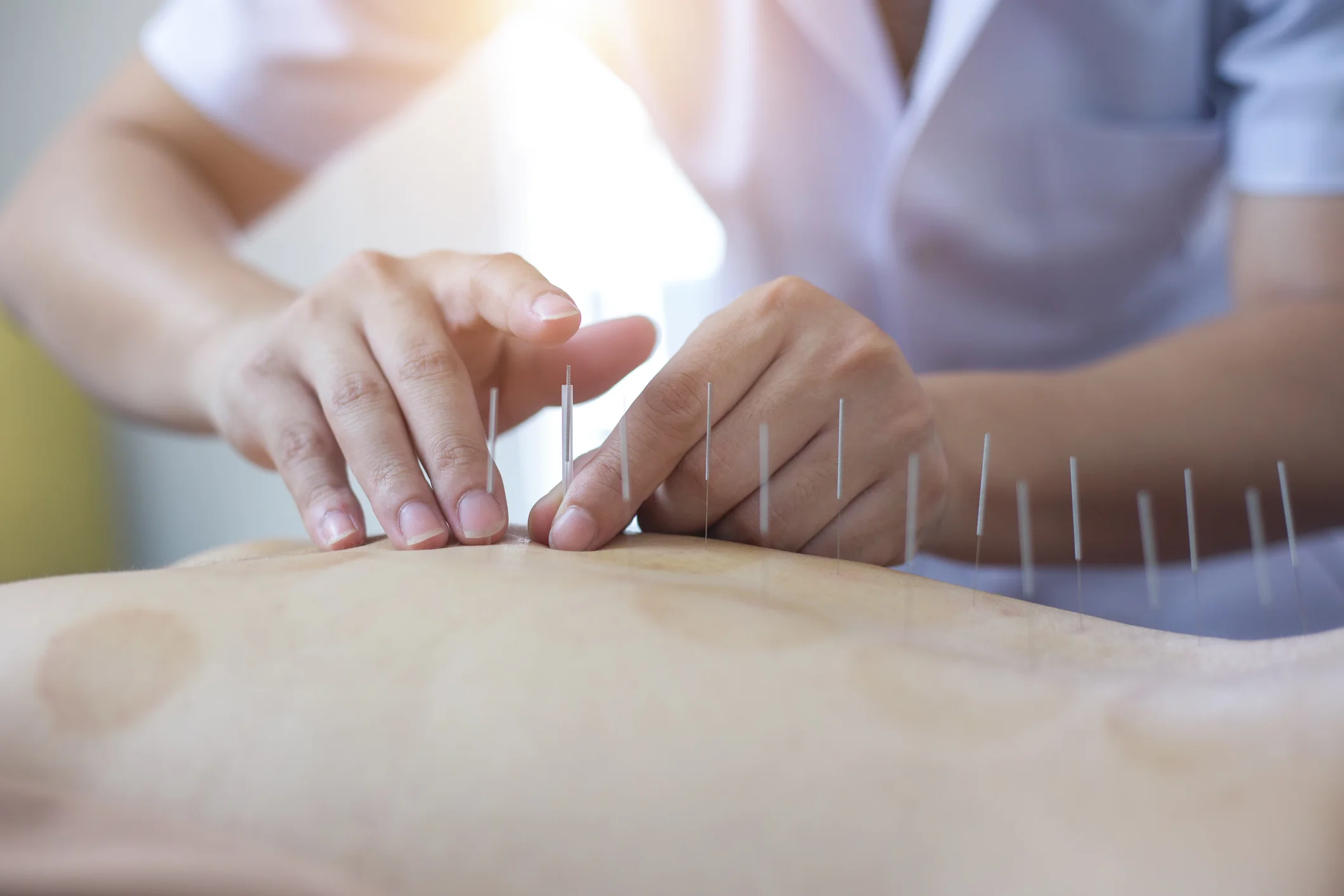 Acupuncture - needle patterning and placement
