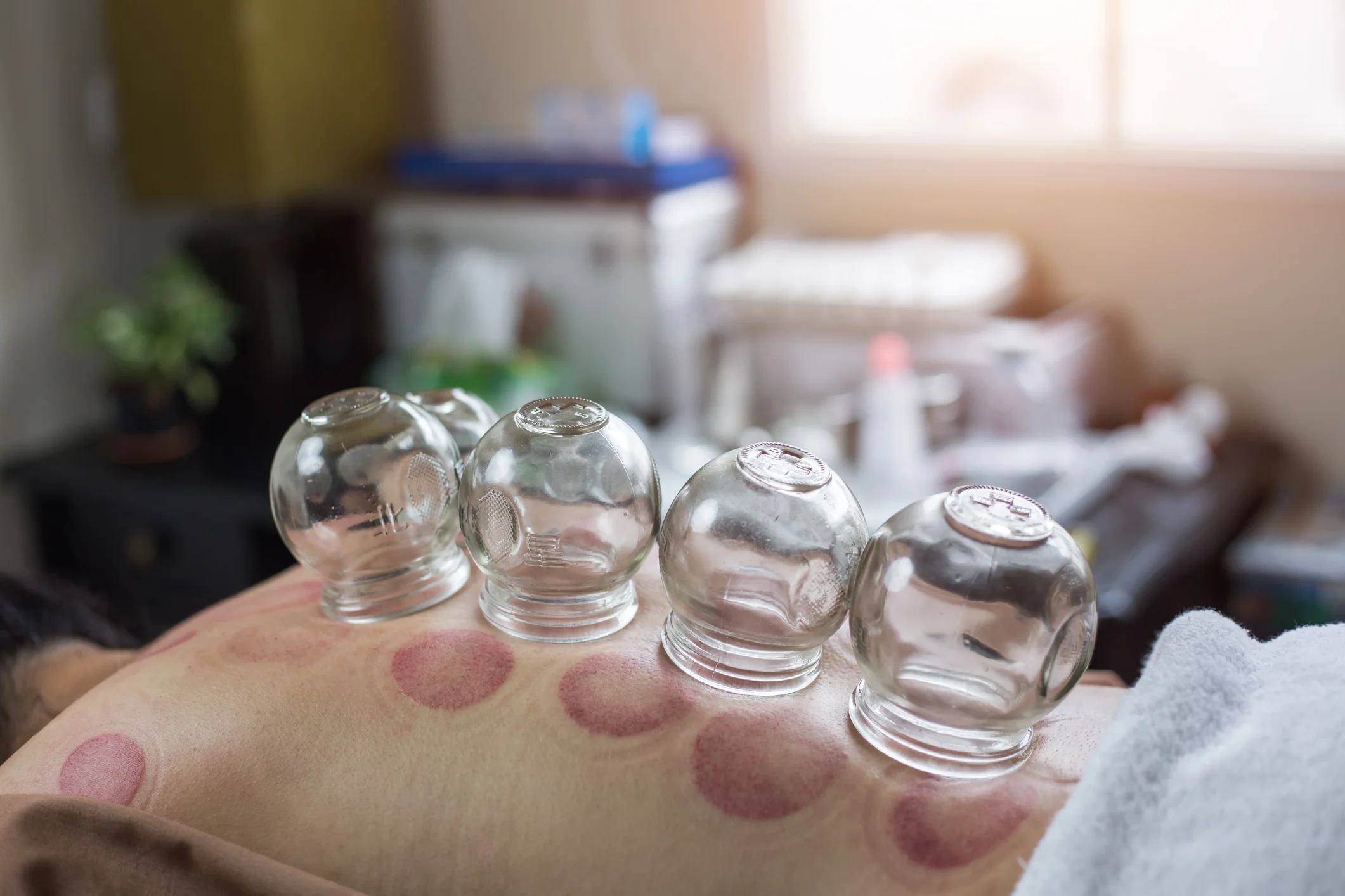 Cupping leaves marks like an octopus gave you a hug! It is increasingly endorsed by professional athletes. Watch for the tell-tale marks above on professional sports franchise stars.