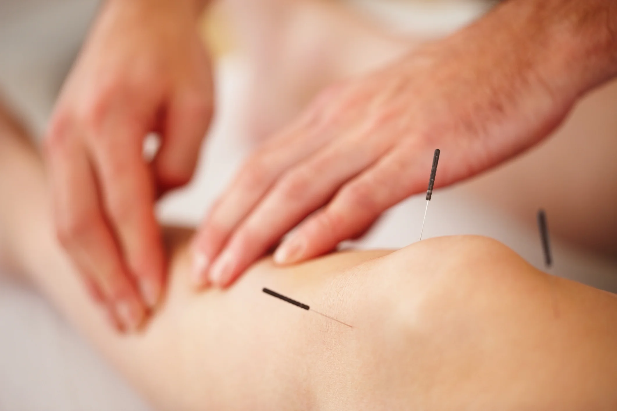 Acupuncture needles may be combined with acupressure work (tuina).