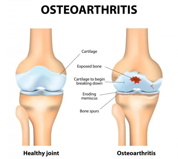 knee-osteo-arthritis.jpg