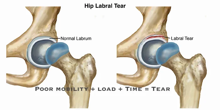 HipLabralTear-LG.jpg