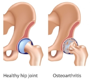 HIP JOINT.jpg