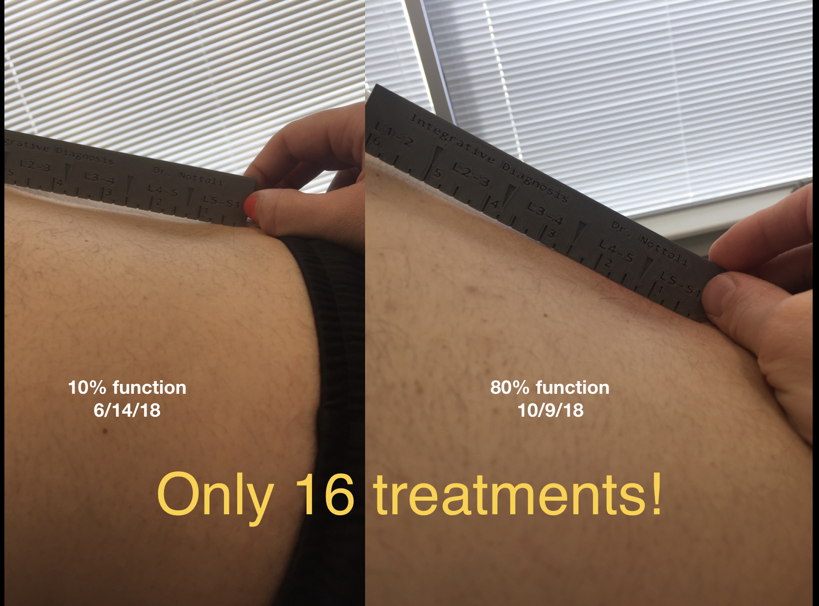 Picture on left is unhealthy lower back function. Picture on the right is healthy lower back function. The low back needs to flex to be healthy.
