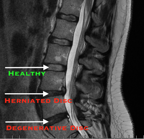 Did you know failed back surgery syndrome (FBSS) exists?