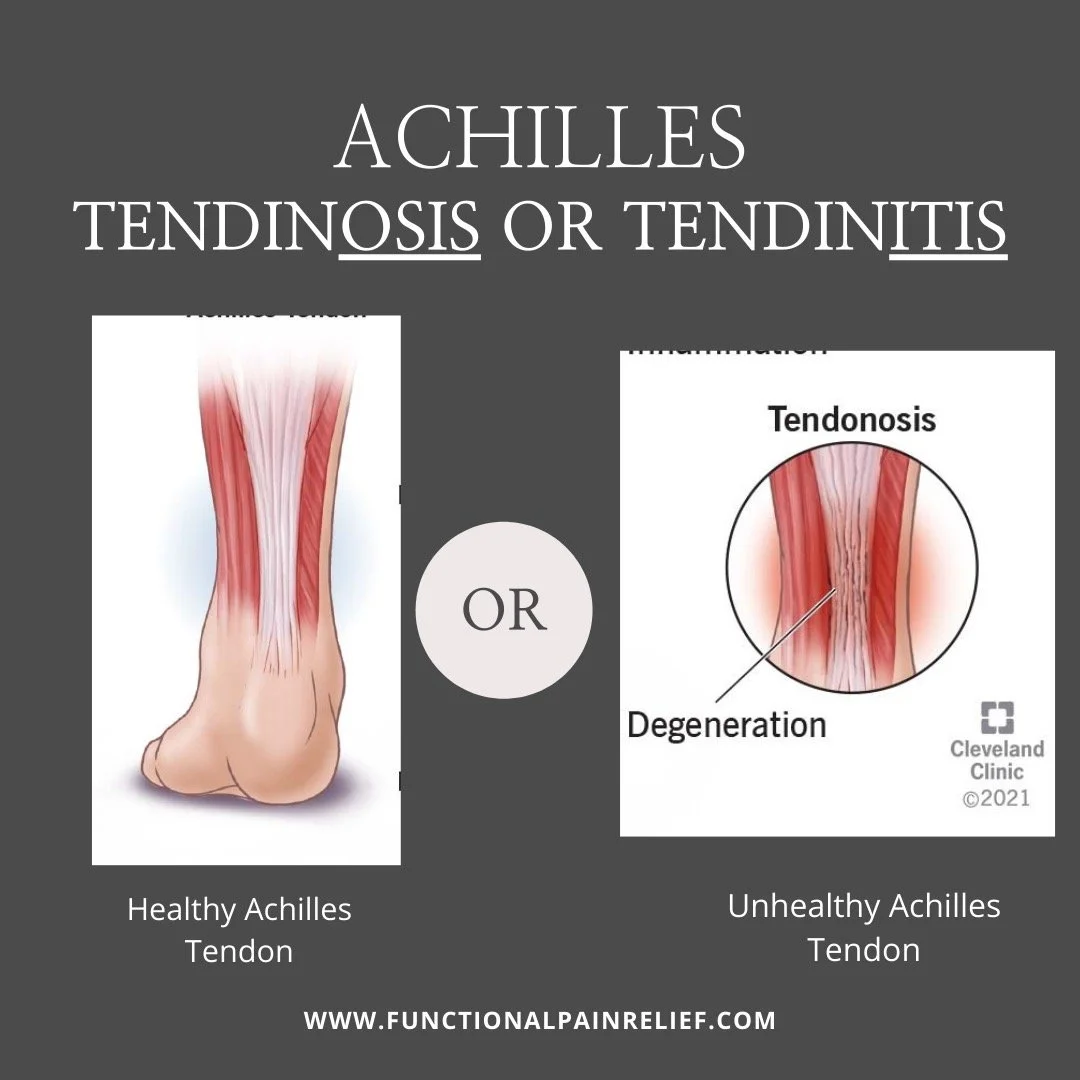 Achilles Tendinitis