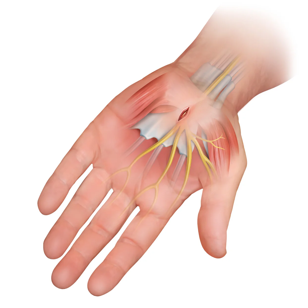 carpal tunnel 4.jpg