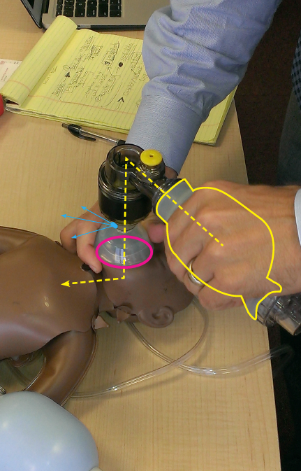 Blue =&nbsp;Help device detect leaksPink = Create a better seal around the infant and the maskYellow = Measure airflow and rate of airflow (fast vs. slow)