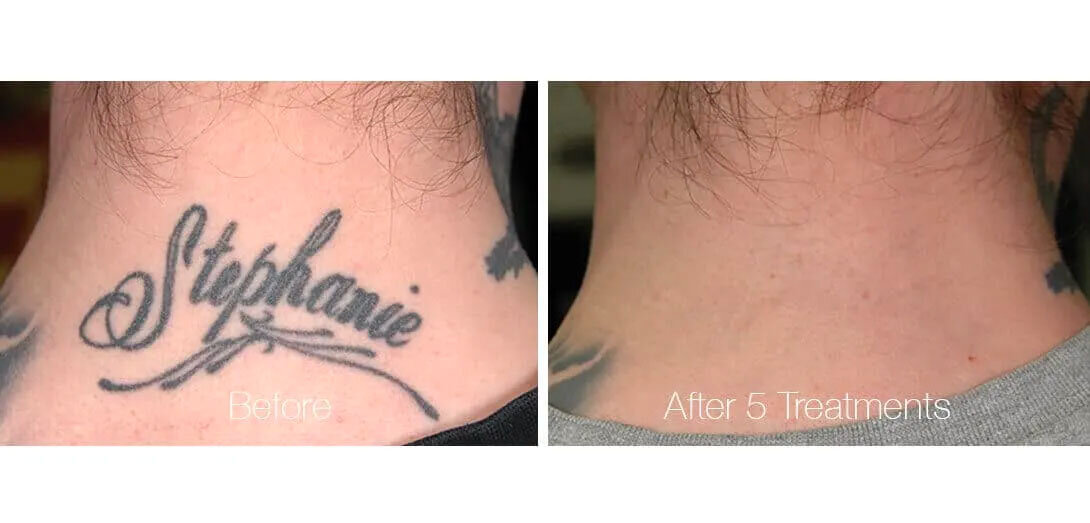 Tattoo Removal — Lemmon Ave. Plastic Surgery & Laser Center