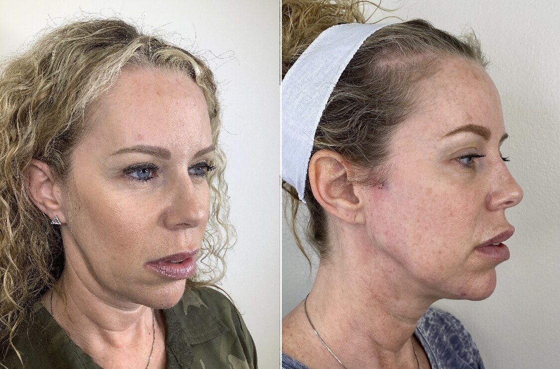 Threads — Lemmon Ave. Plastic Surgery & Laser Center
