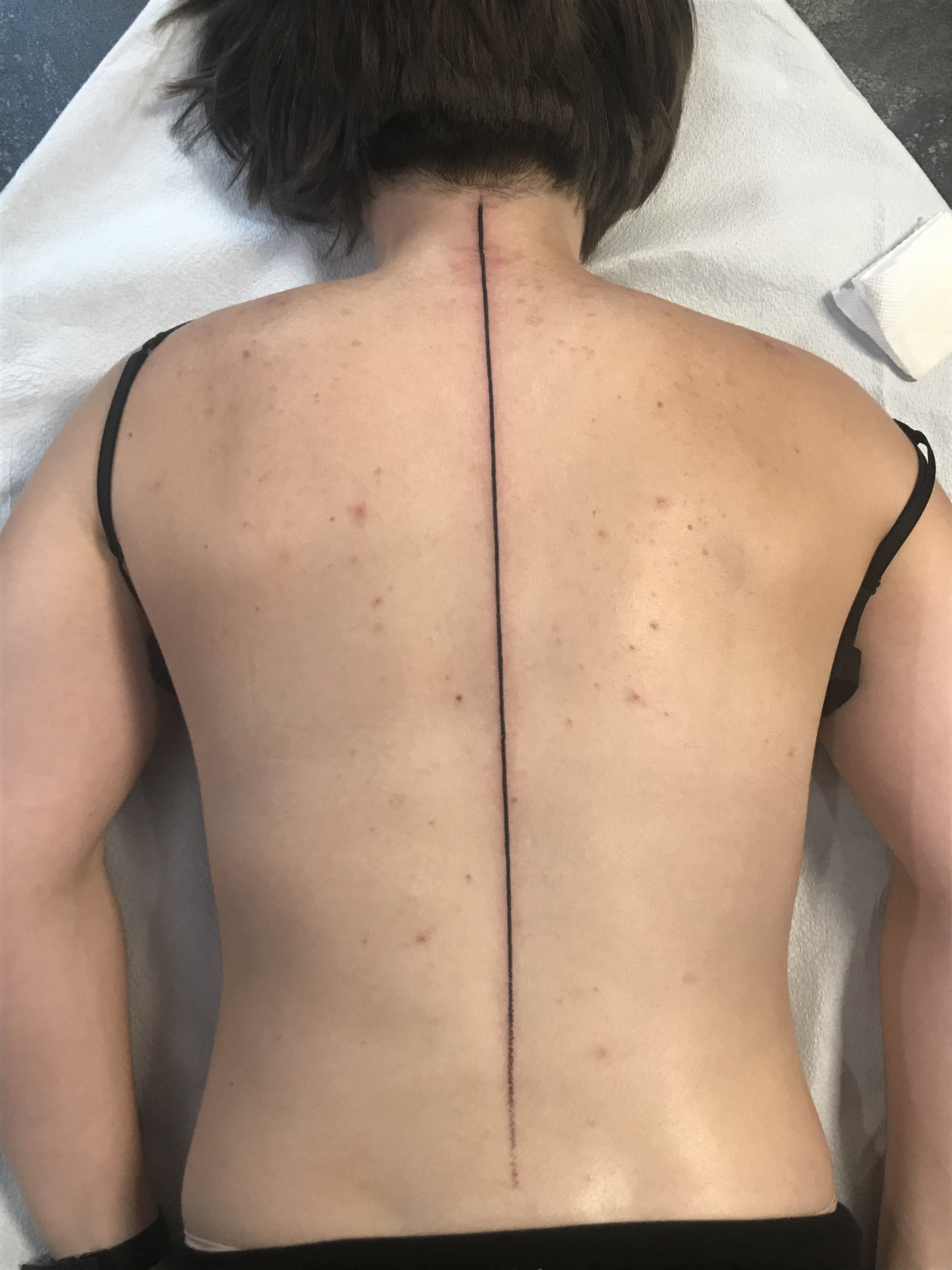 Pin on Scoliosis
