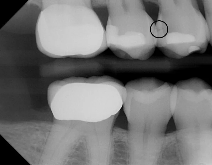 Using digital imaging, we are able to detect decay that is not visible with a visual exam. 