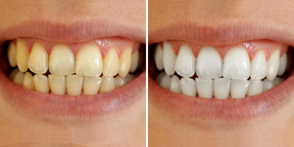 teeth-whitening-before-after.jpg