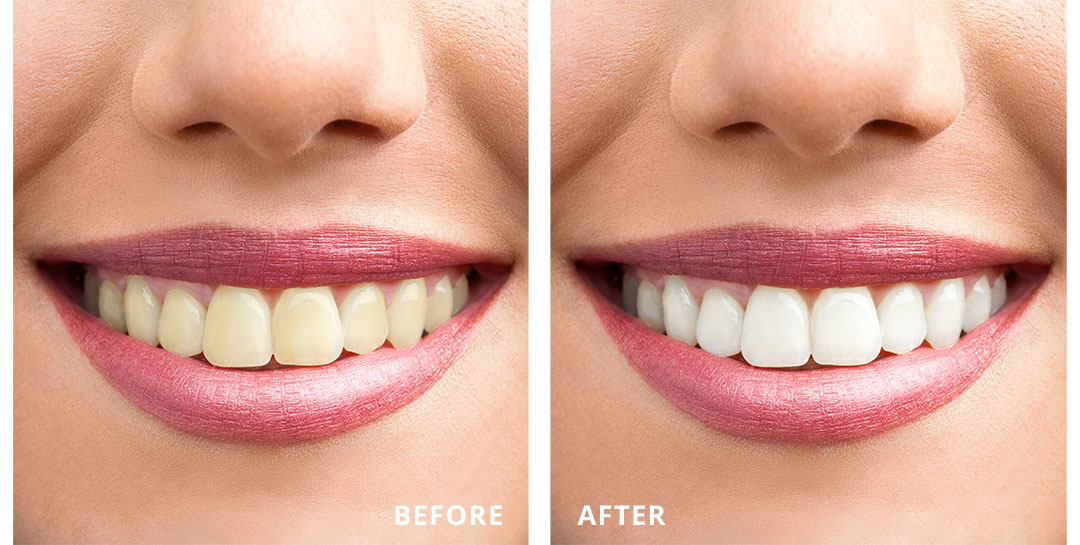 northgate-dental-sinsational-smile-teeth-whitening-before-after.jpg