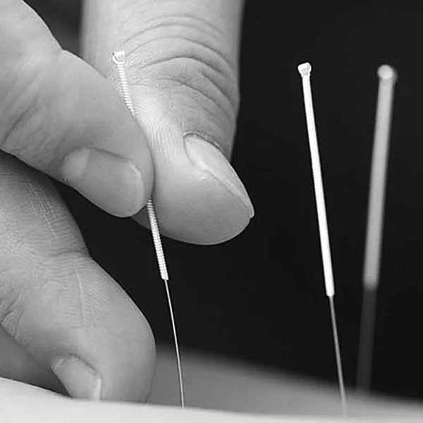 Acupuncture Treatment for chronic pain, sports related injuries and more.
