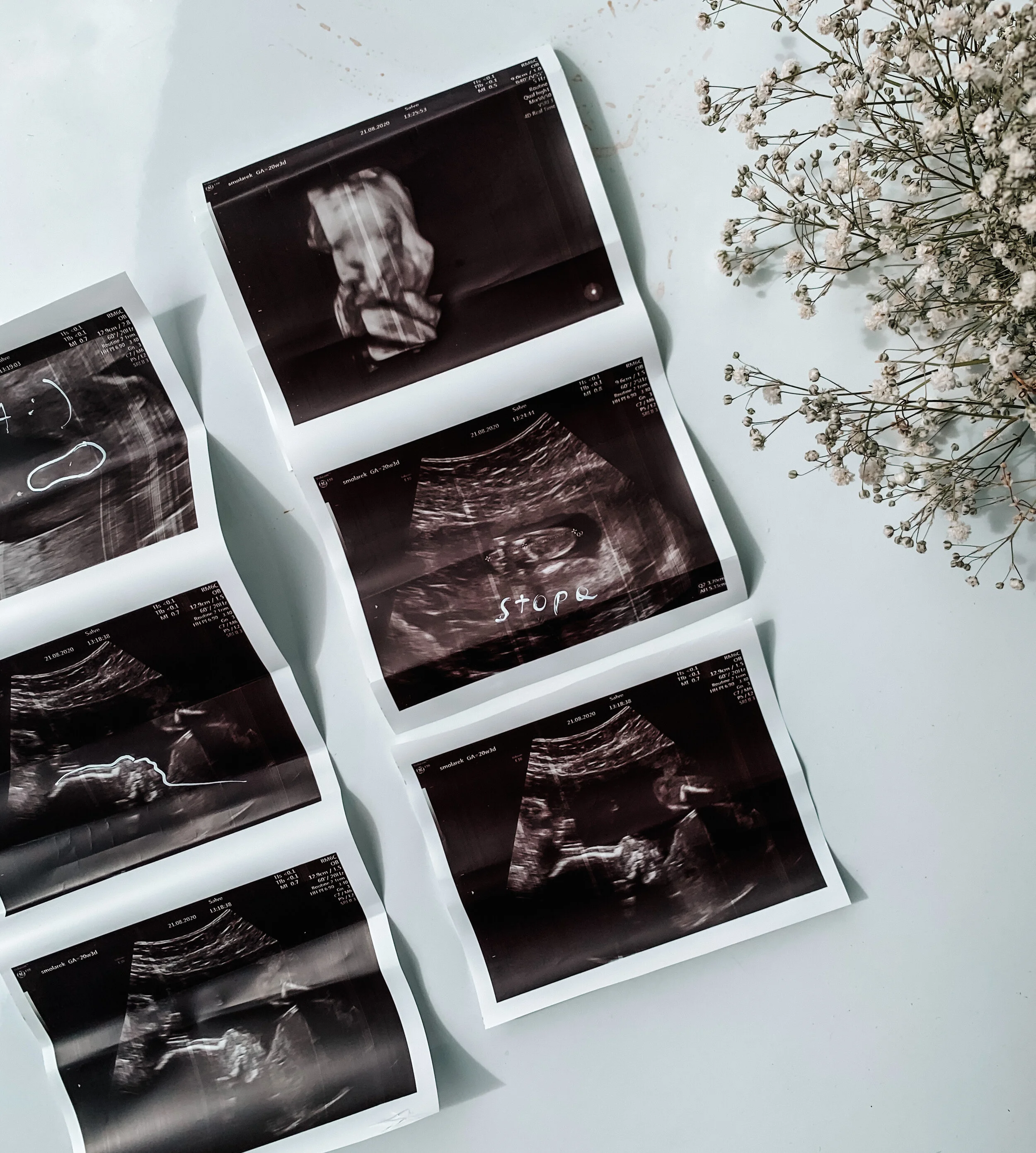 BADANIA USG PRENATALNE W CIĄŻY - CO MUSISZ WIEDZIEĆ