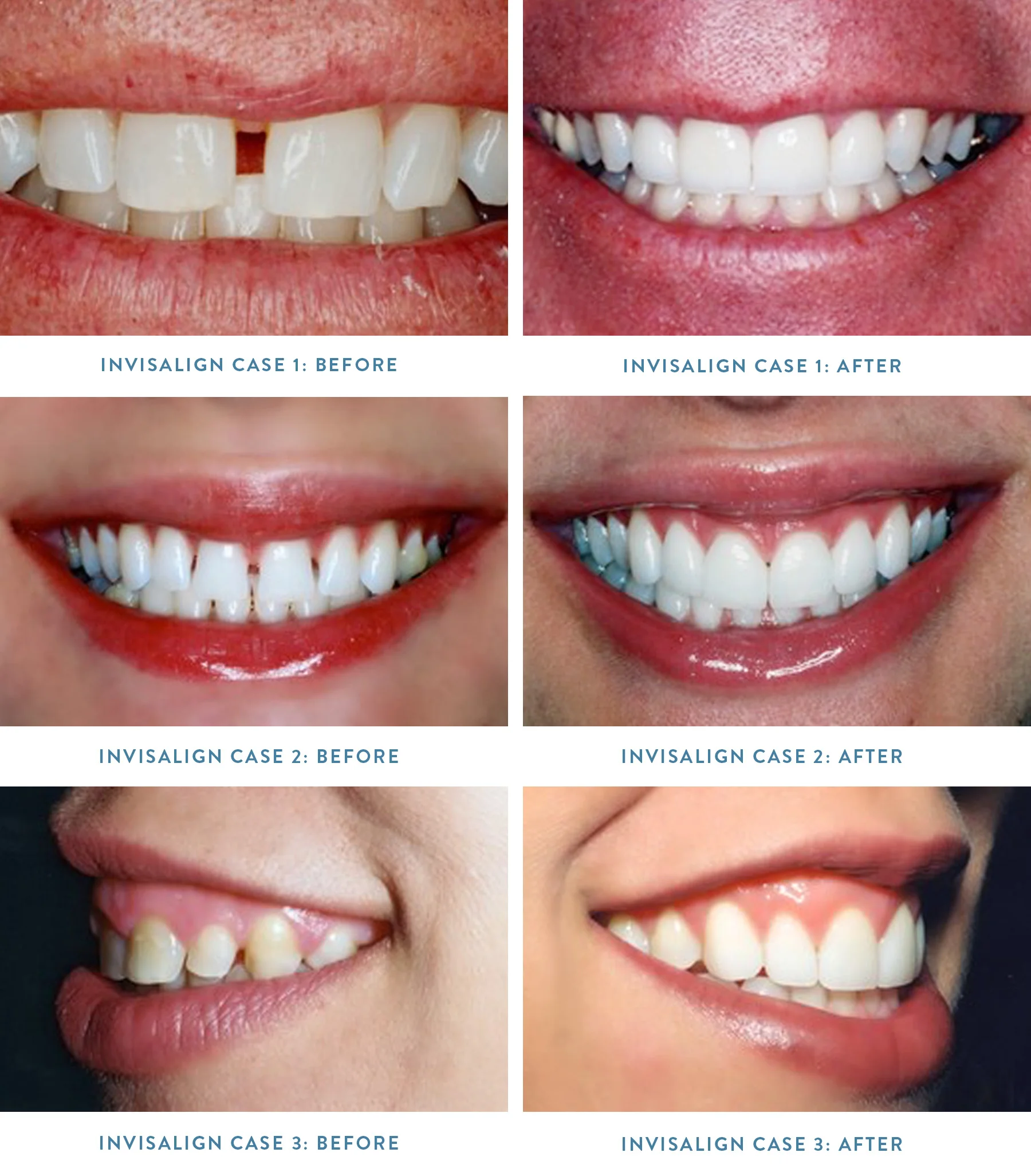 3- INVISALIGN- PICTURES.jpg