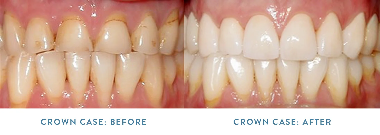 The patient above, received 8 porcelain crowns on the upper arch (top row) of teeth in order to treat stained edges, wearing, chipping, and some gumline recession. After the treatment, the edges are now uniform and the patient has longer, better-shaped teeth to enhance the smile and aid in chewing/biting function.