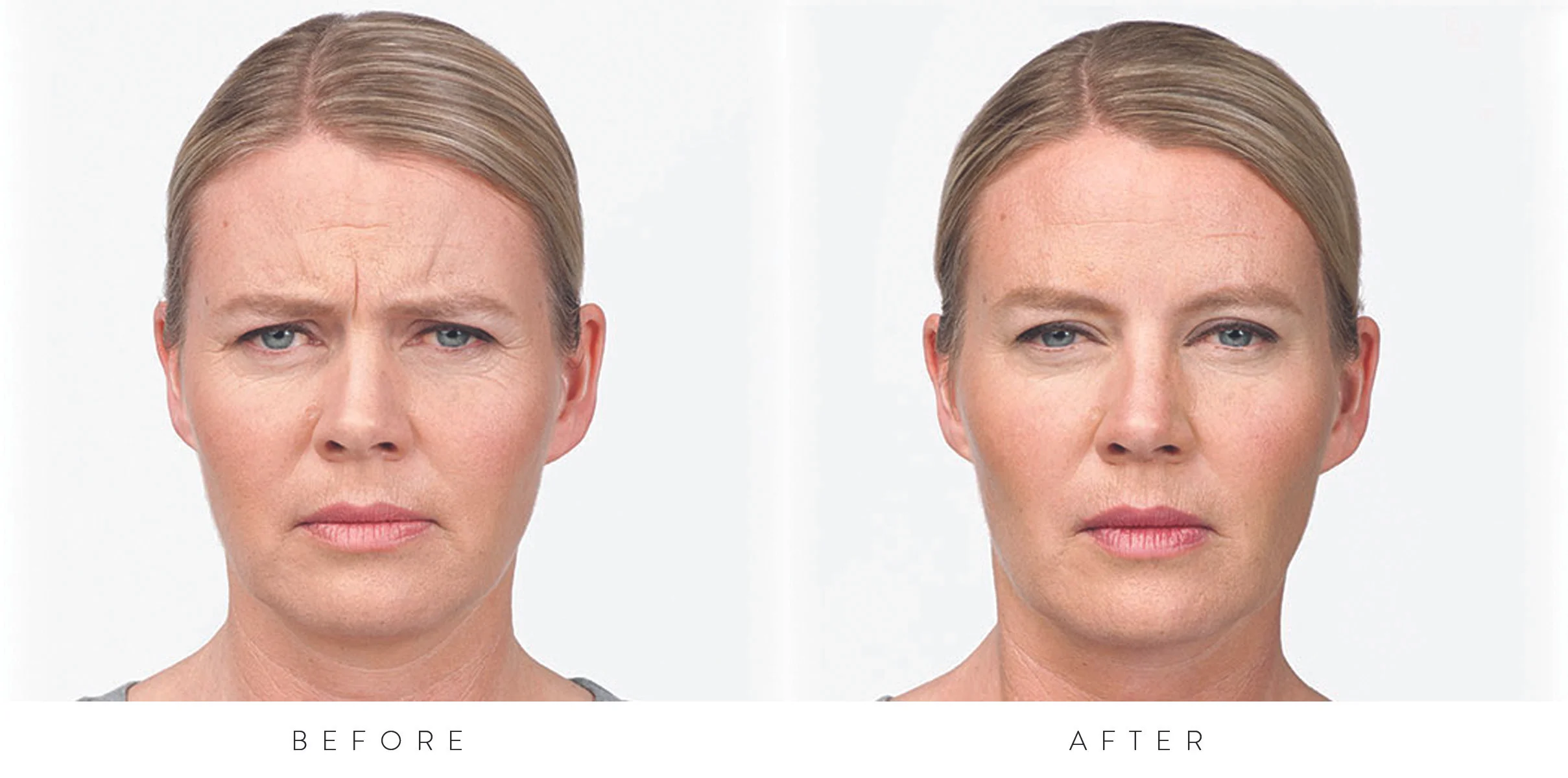 BOTOX.jpg