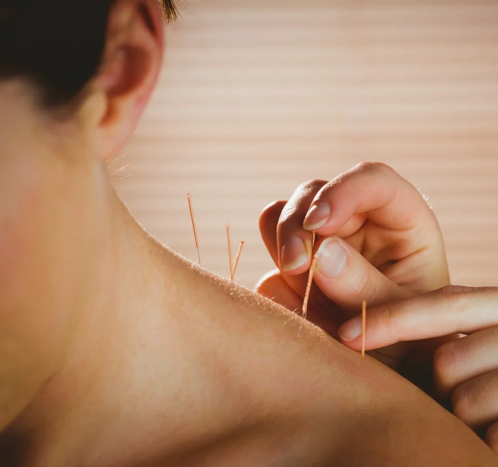acupuncture.jpg