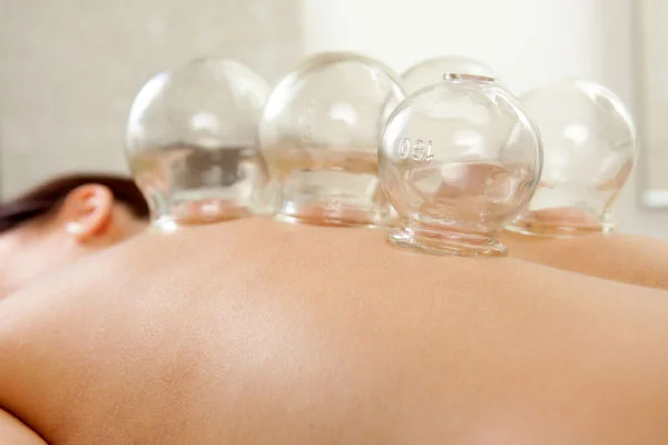 Cupping.jpg