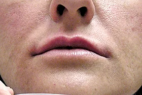 After Facial Wrinkle Fillers : Upper Lip