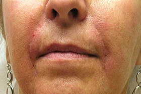 After Facial Fillers: Nasolabial Folds